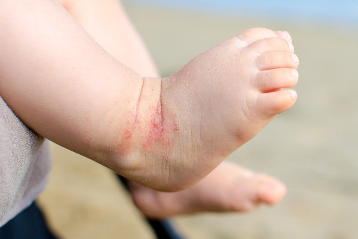 Eczéma - WE ARE CLEAN - CLEAN BEAUTY Image