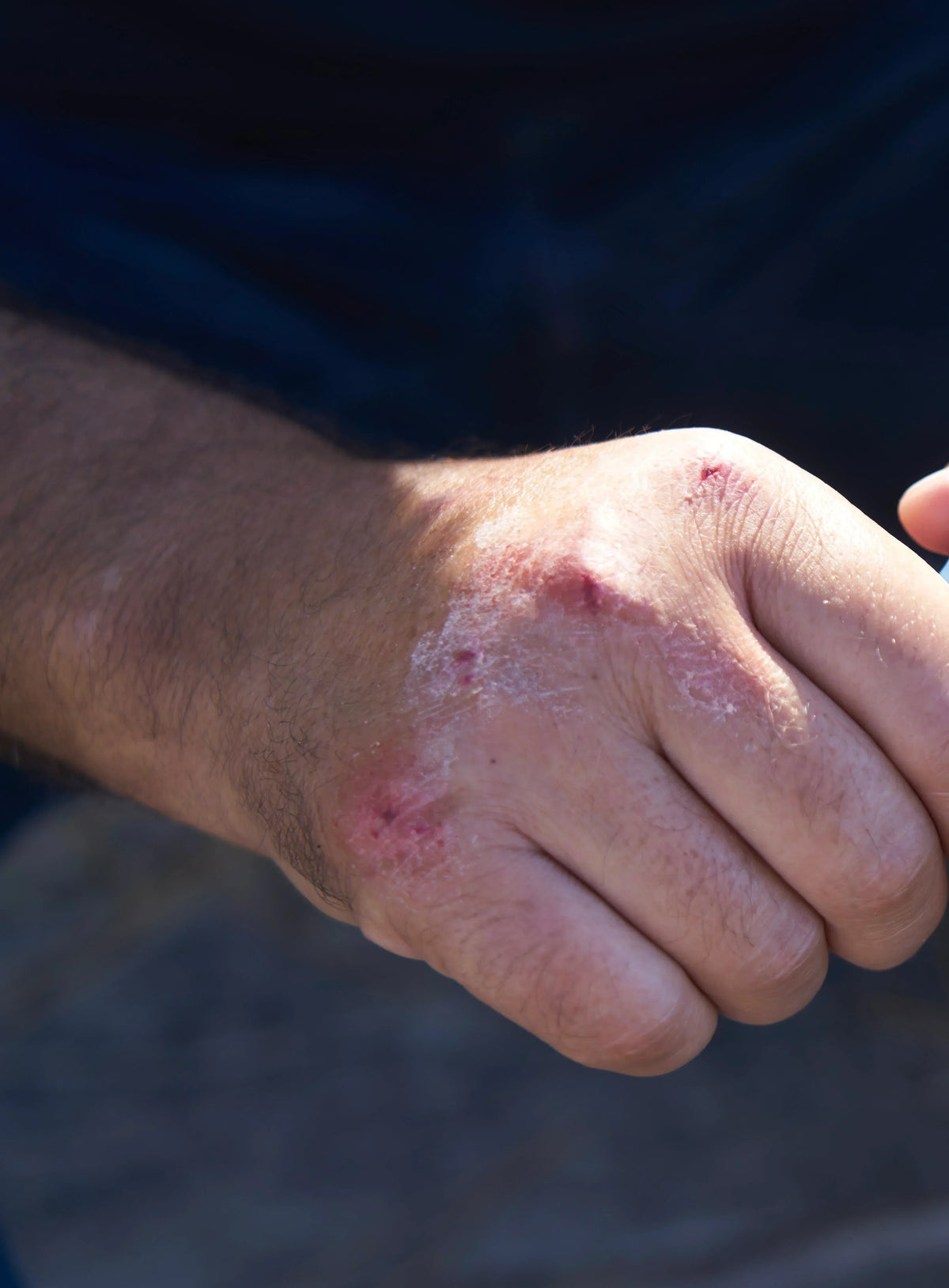 Comment reconnaître un psoriasis ? Image