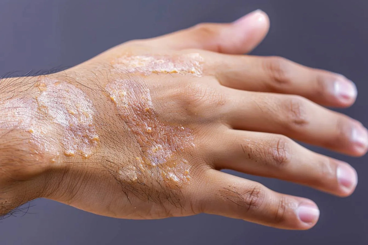 Quelles sont les complications possibles du psoriasis ? Image