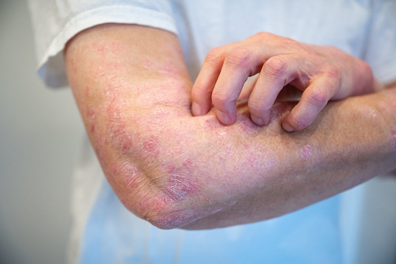 Quelles sont les causes du psoriasis ? Image