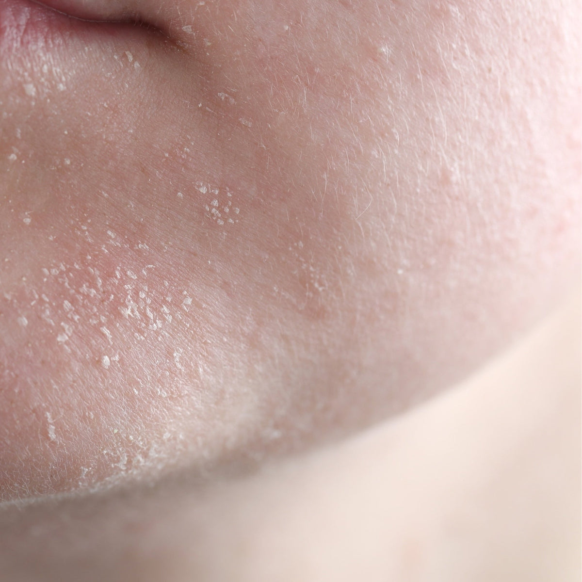 Comment soigner une peau très sèche ?