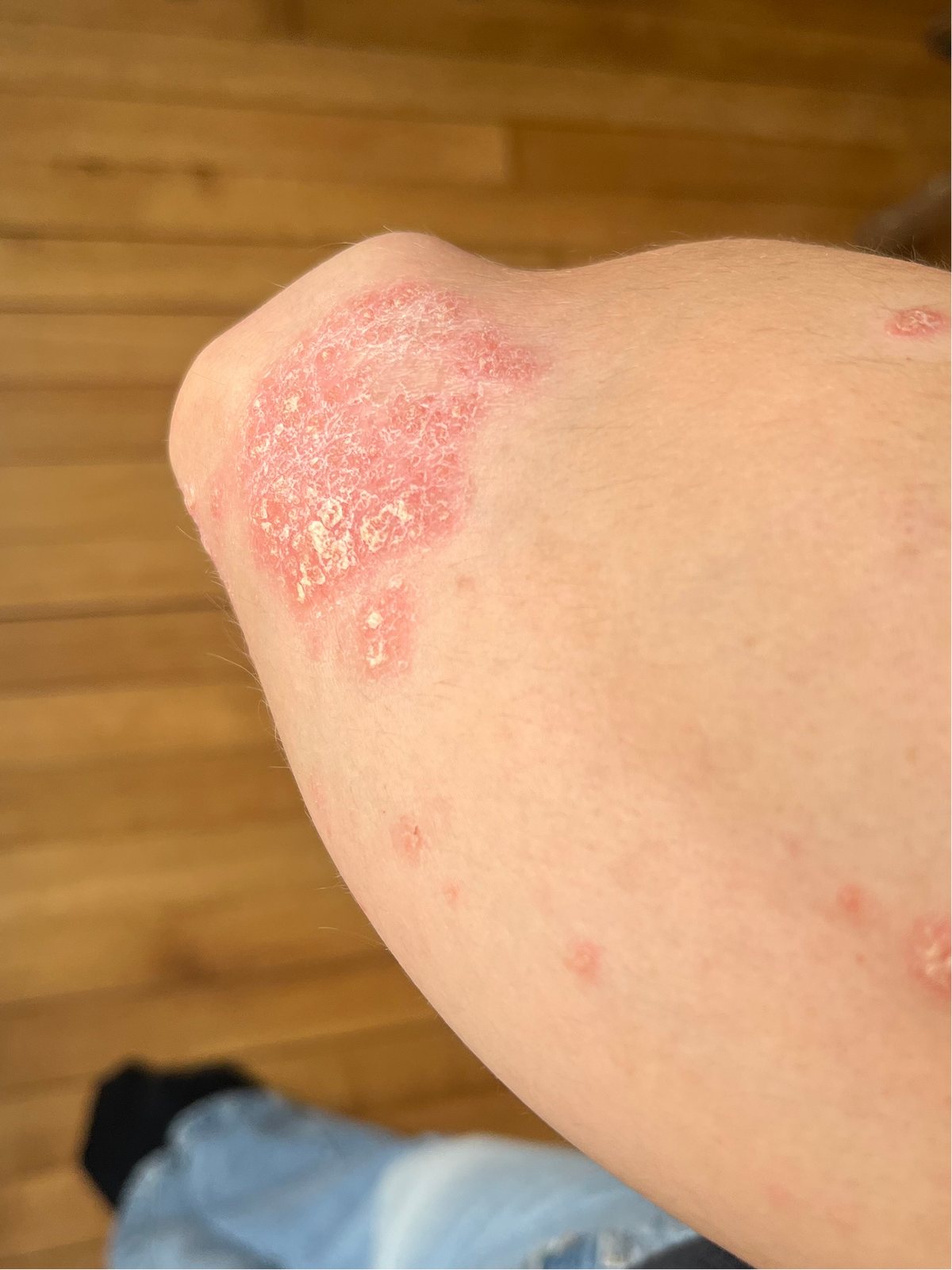 Quels sont les types de psoriasis ? Image