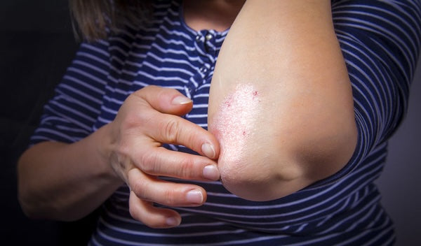 Où apparait le psoriasis ? Image