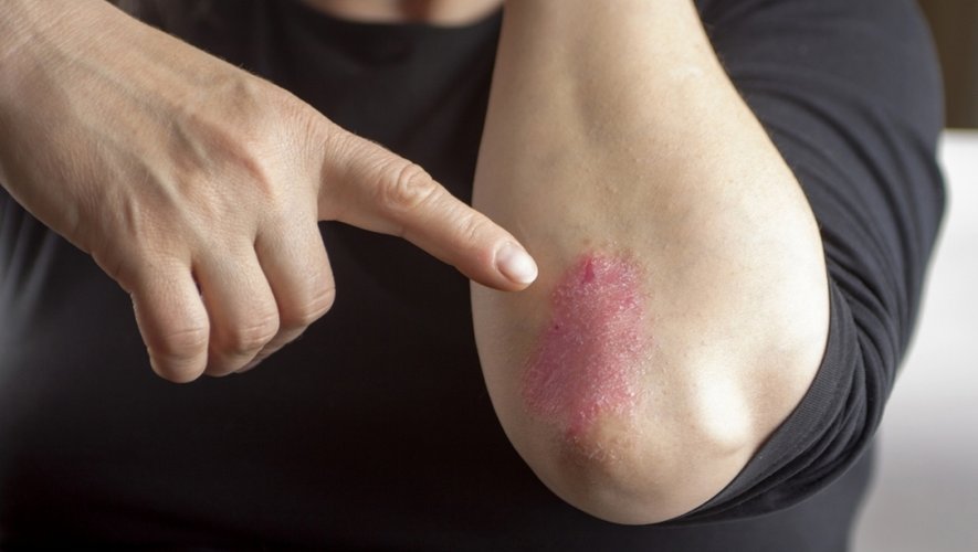 Psoriasis : symptômes, causes et traitements Image