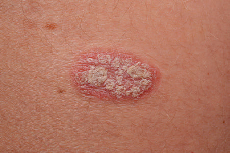 Quels sont les traitements naturels du psoriasis ? Image