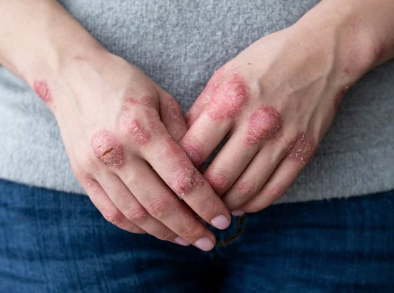 Qui est touché par le psoriasis ? Image