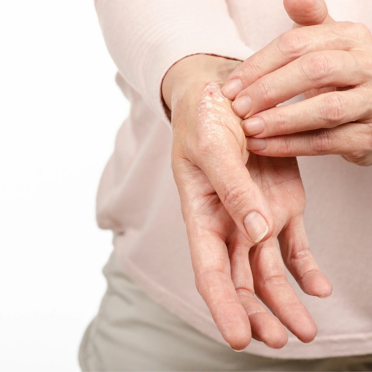 Psoriasis ou dermatite atopique ? Image